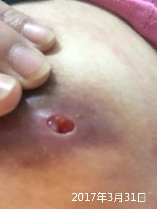 原始点调理乳房溃烂:一位德国媳妇飞越半球的原始点求医经历 原始点调理乳房溃烂:一位德国媳妇飞越半球的原始点求医经历