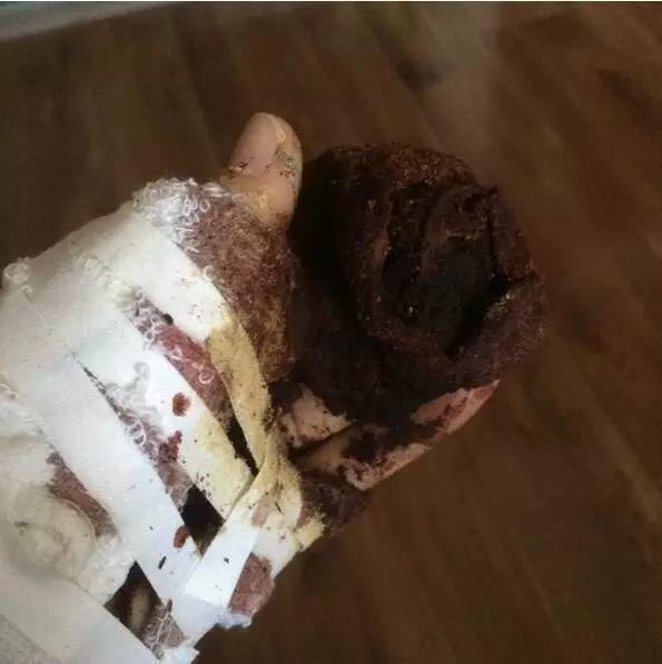 本中心学员花开伊宁:原始点处理夹断手指,效果杠杠的 本中心学员花开伊宁:原始点处理夹断手指,效果杠杠的