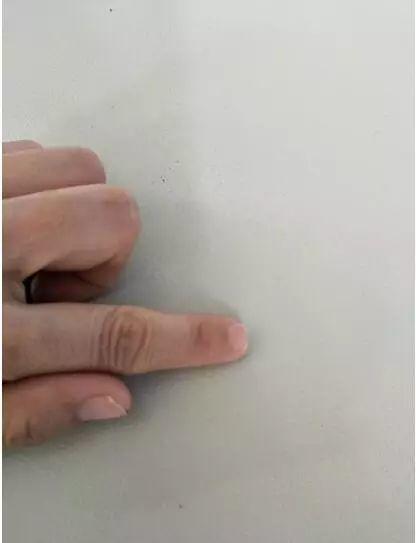 本中心学员花开伊宁:原始点处理夹断手指,效果杠杠的 本中心学员花开伊宁:原始点处理夹断手指,效果杠杠的