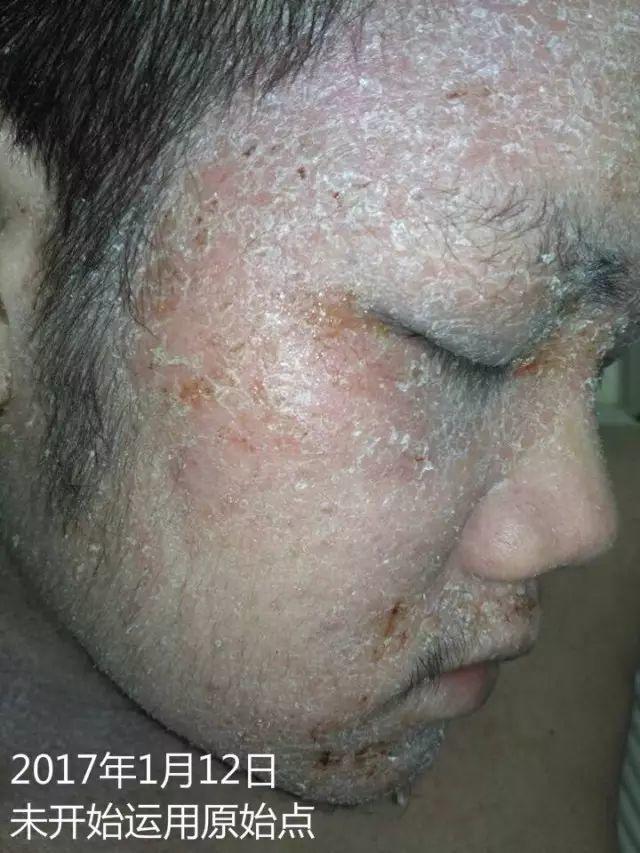 原始点调理23年严重湿疹：《21天的震撼》