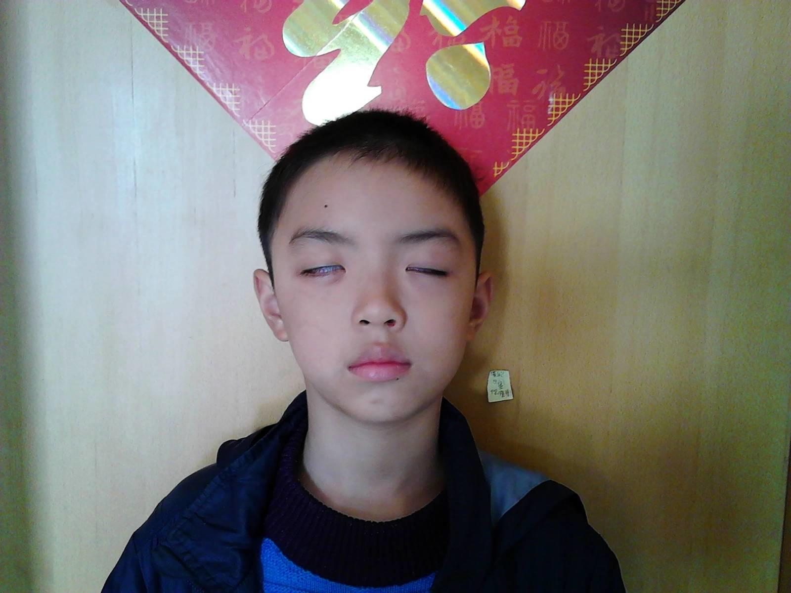 用原始点理疗病毒性脑炎后遗症三个月好了一大半 用原始点理疗病毒性脑炎后遗症三个月好了一大半