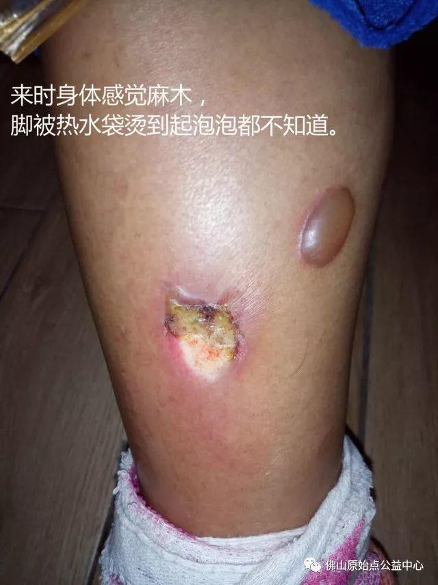 原始点调理全身麻木疼痛肿胀案例 原始点调理全身麻木疼痛肿胀案例