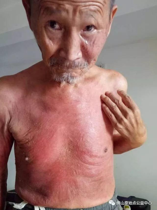 原始点调理全身肿胀溃烂:九个月,雨过天睛 原始点调理全身肿胀溃烂:九个月,雨过天睛