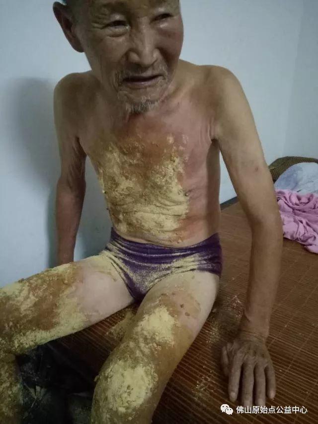 原始点调理全身肿胀溃烂:九个月,雨过天睛 原始点调理全身肿胀溃烂:九个月,雨过天睛