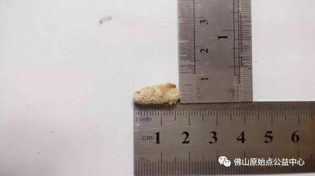 本中心学员花开深圳,原始点调理,先后自然排出肾结石 本中心学员花开深圳,原始点调理,先后自然排出肾结石