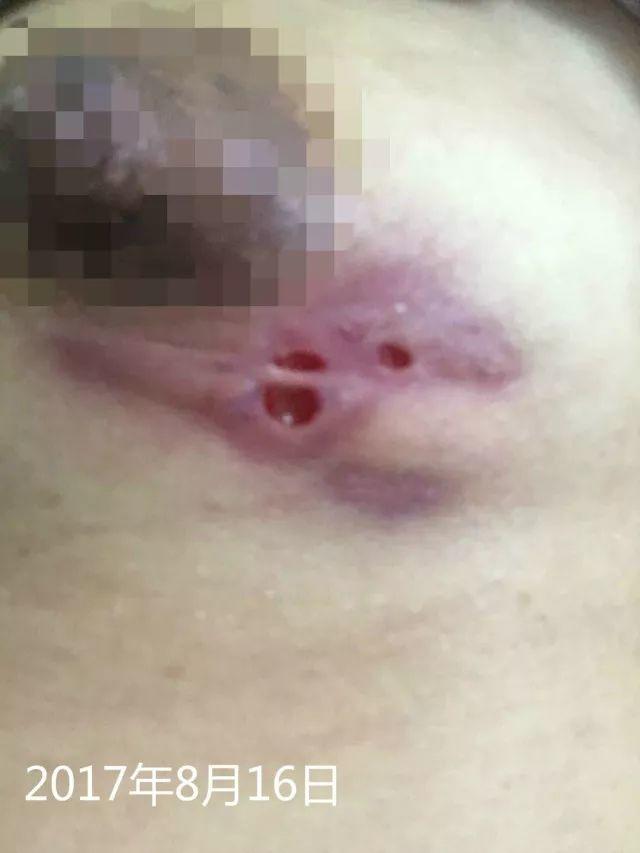 原始点调理乳房溃烂:一位德国媳妇飞越半球的原始点求医经历 原始点调理乳房溃烂:一位德国媳妇飞越半球的原始点求医经历