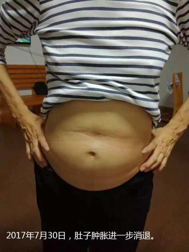 原始点调理腹水双下肢水肿:清晰的观念+信心 成就健康 原始点调理腹水双下肢水肿:清晰的观念+信心 成就健康