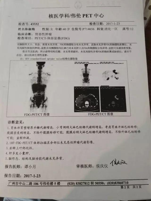 原始点调理胃癌：云淡风轻