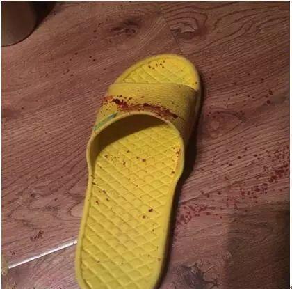 本中心学员花开伊宁:原始点处理夹断手指,效果杠杠的 本中心学员花开伊宁:原始点处理夹断手指,效果杠杠的