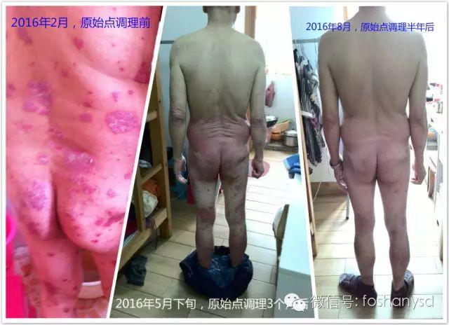 触目惊心 原始点调理八年病史牛皮癣,半年基本恢复健康 触目惊心 原始点调理八年病史牛皮癣,半年基本恢复健康