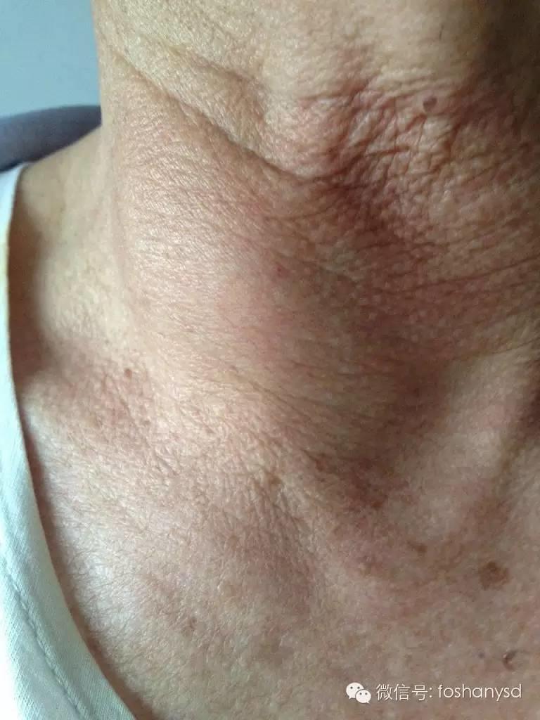 甲状腺结节、冠心病和高血压遇到原始点后症状基本化解 甲状腺结节、冠心病和高血压遇到原始点后症状基本化解