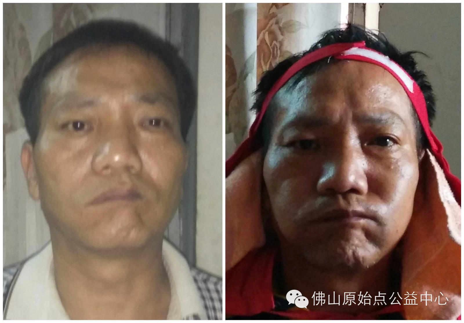 面瘫用原始点20天完全康复