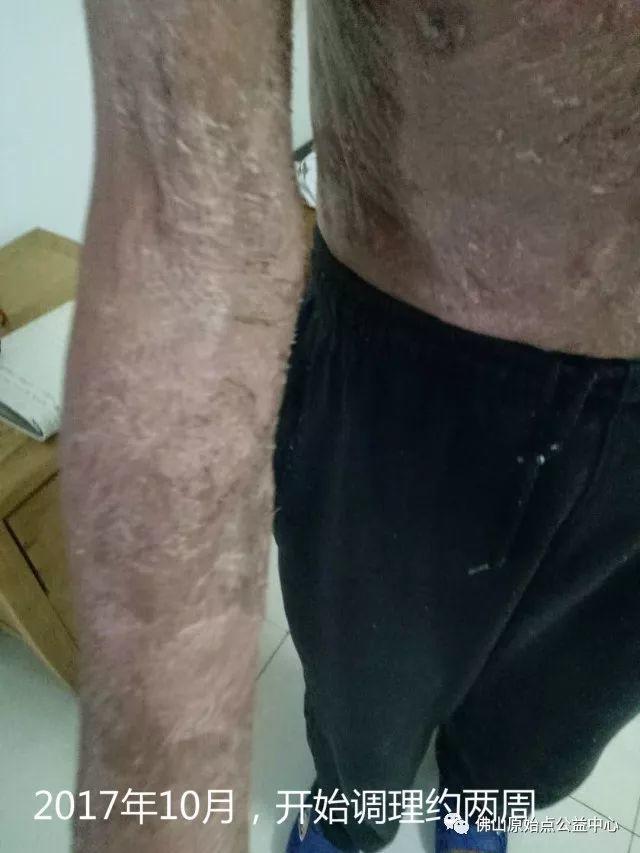 原始点调理全身肿胀溃烂:九个月,雨过天睛 原始点调理全身肿胀溃烂:九个月,雨过天睛