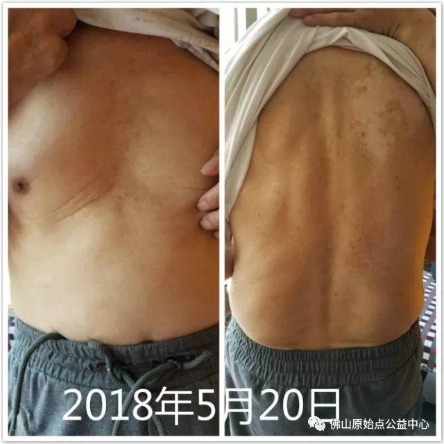 原始点调理全身肿胀溃烂:九个月,雨过天睛 原始点调理全身肿胀溃烂:九个月,雨过天睛