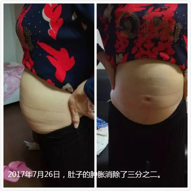 原始点调理腹水双下肢水肿:清晰的观念+信心 成就健康 原始点调理腹水双下肢水肿:清晰的观念+信心 成就健康