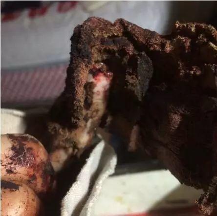 本中心学员花开伊宁:原始点处理夹断手指,效果杠杠的 本中心学员花开伊宁:原始点处理夹断手指,效果杠杠的