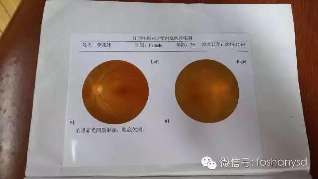 因眼睛问题用原始点调理身体一个多月，意外减肥20斤