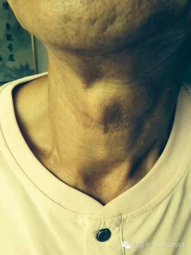 甲状腺结节、冠心病和高血压遇到原始点后症状基本化解 甲状腺结节、冠心病和高血压遇到原始点后症状基本化解