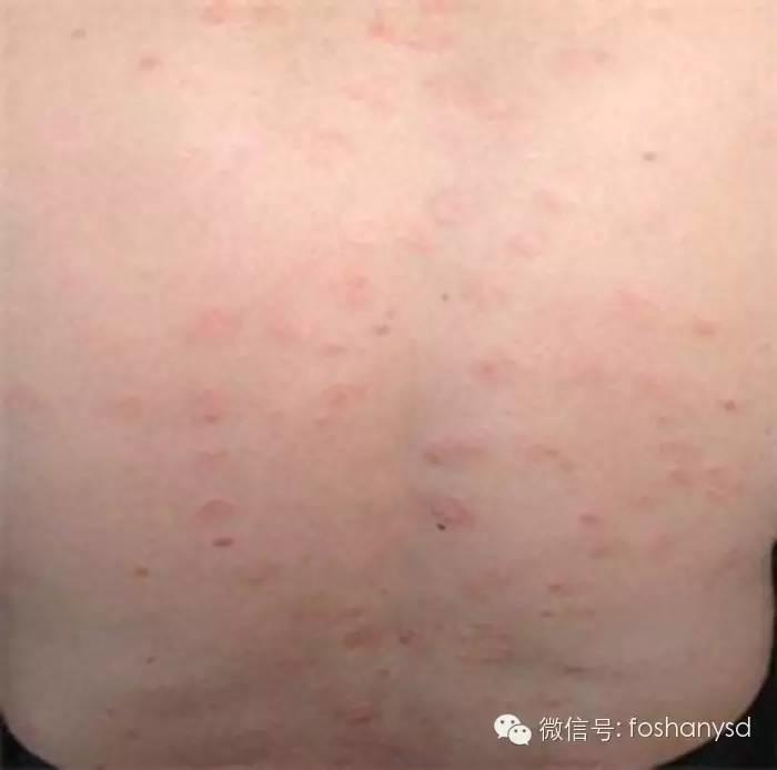 16年牛皮癣康复案例分享 16年牛皮癣康复案例分享