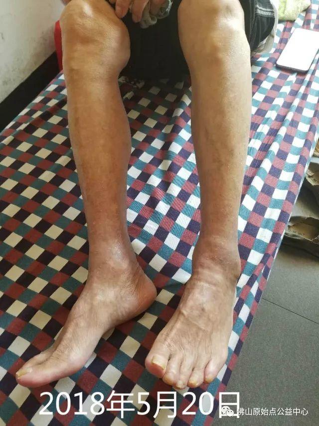 原始点调理全身肿胀溃烂:九个月,雨过天睛 原始点调理全身肿胀溃烂:九个月,雨过天睛