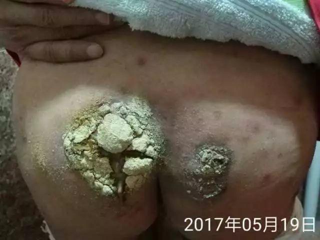 原始点调理淋巴瘤严重溃烂:无任何介入治疗愈合 原始点调理淋巴瘤严重溃烂:无任何介入治疗愈合