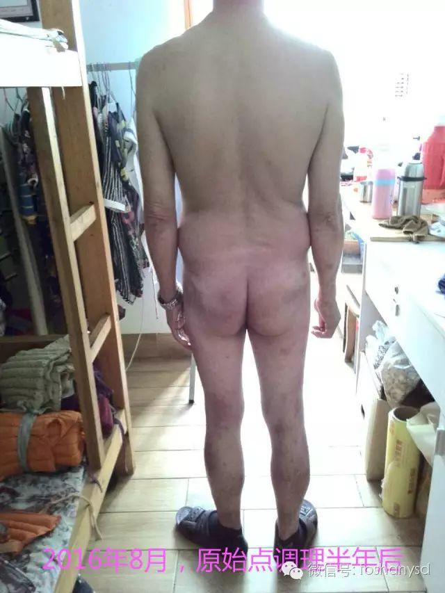 触目惊心 原始点调理八年病史牛皮癣,半年基本恢复健康 触目惊心 原始点调理八年病史牛皮癣,半年基本恢复健康