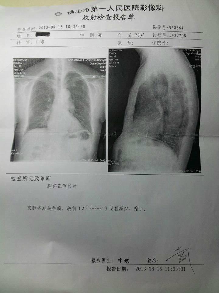 用原始点理疗前列腺癌晚期一年身体恢复到正常状态