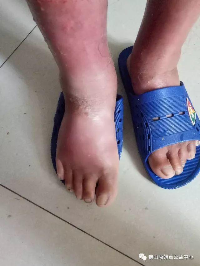 原始点调理全身肿胀溃烂:九个月,雨过天睛 原始点调理全身肿胀溃烂:九个月,雨过天睛