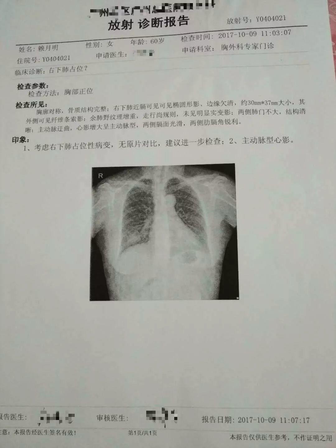 原始点调理肺部肿瘤：细节到位效果好