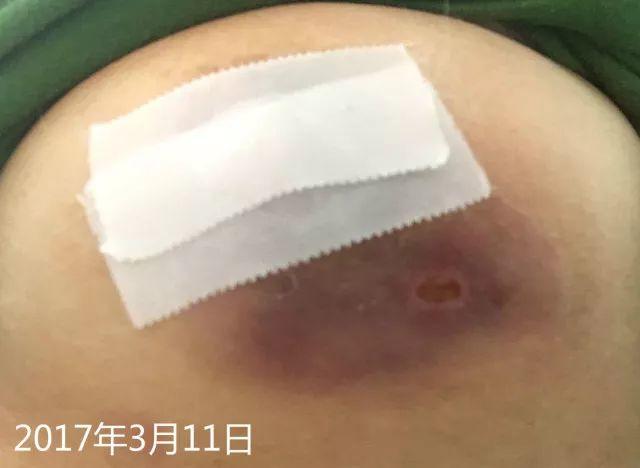 原始点调理乳房溃烂:一位德国媳妇飞越半球的原始点求医经历 原始点调理乳房溃烂:一位德国媳妇飞越半球的原始点求医经历