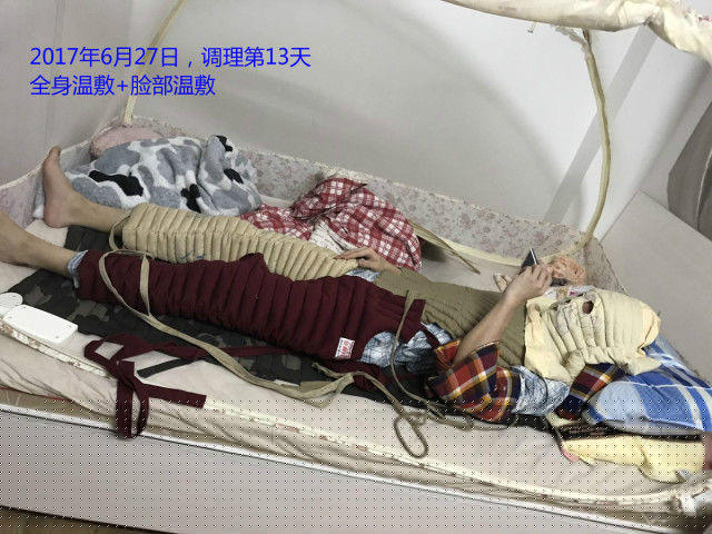 原始点调理严重湿疹：找回帅气的自己