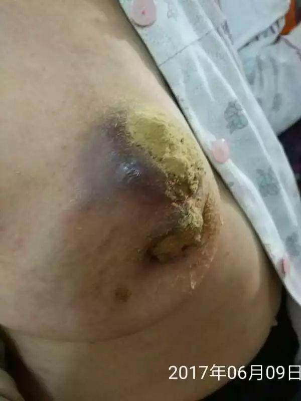 原始点调理乳腺癌伤口溃烂:好好做,效果看得见 原始点调理乳腺癌伤口溃烂:好好做,效果看得见