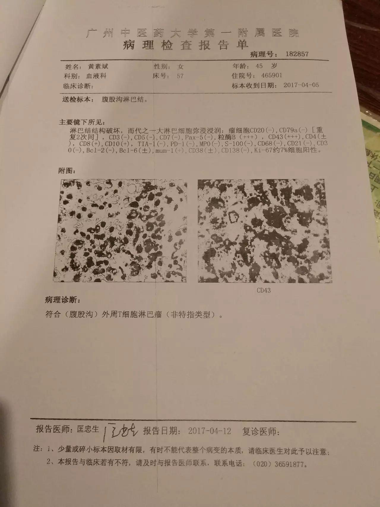 原始点调理淋巴瘤严重溃烂：无任何介入治疗愈合