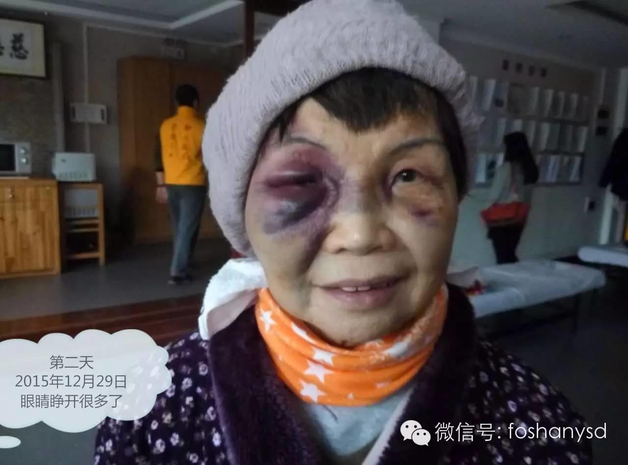 原始点处理摔伤淤肿杠杠的 原始点处理摔伤淤肿杠杠的