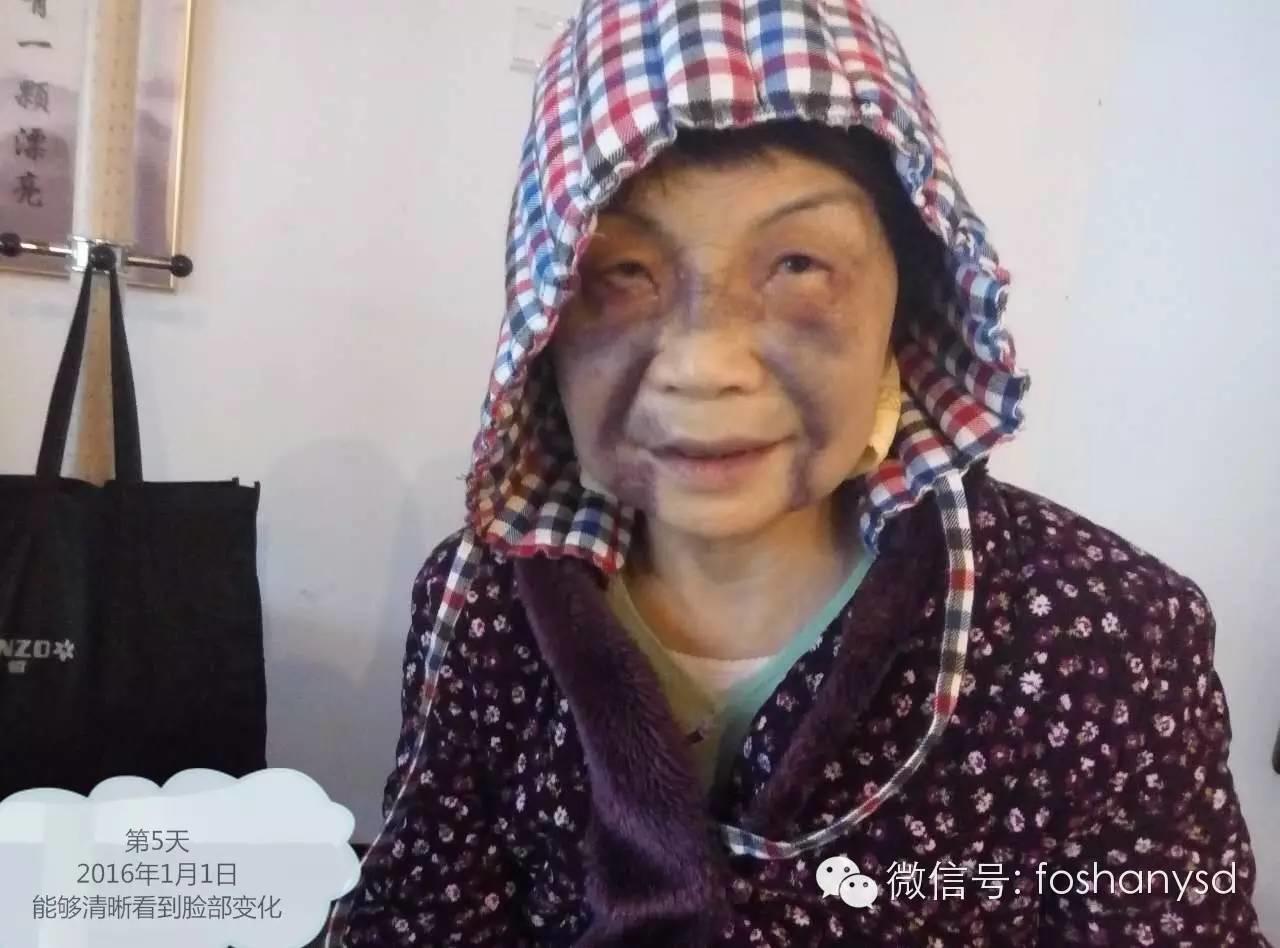 原始点处理摔伤淤肿杠杠的 原始点处理摔伤淤肿杠杠的