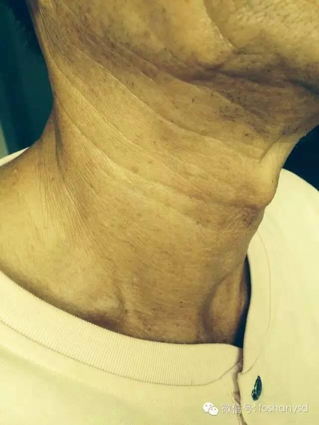 甲状腺结节、冠心病和高血压遇到原始点后症状基本化解 甲状腺结节、冠心病和高血压遇到原始点后症状基本化解