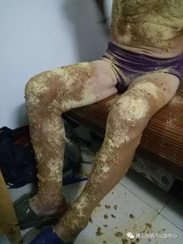 原始点调理全身肿胀溃烂:九个月,雨过天睛 原始点调理全身肿胀溃烂:九个月,雨过天睛