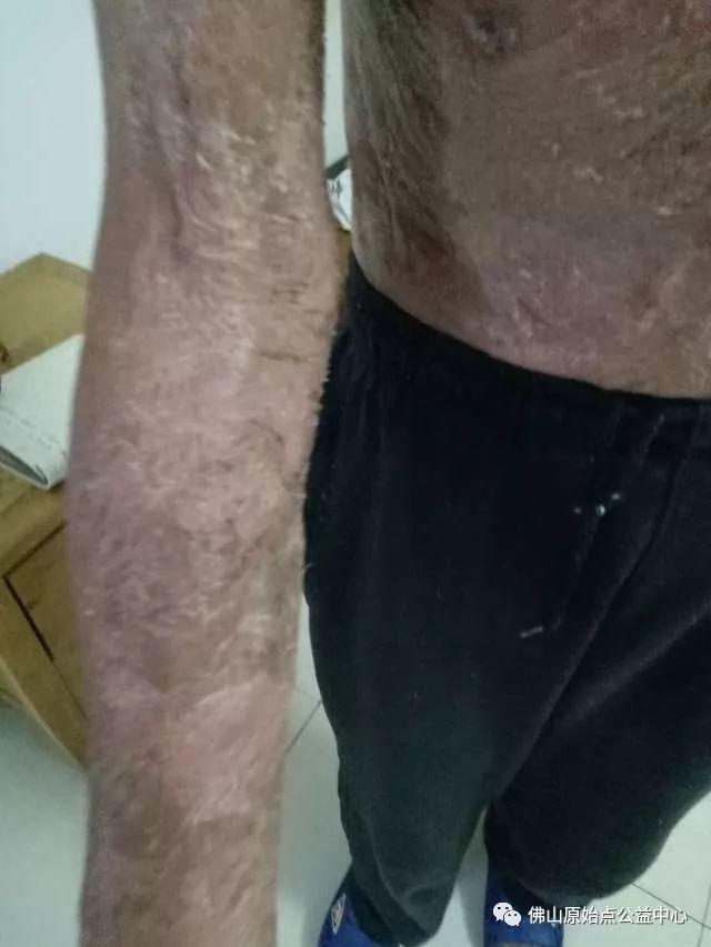 原始点调理全身肿胀溃烂:九个月,雨过天睛 原始点调理全身肿胀溃烂:九个月,雨过天睛