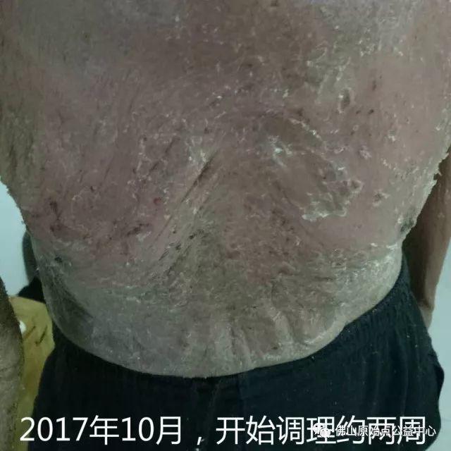 原始点调理全身肿胀溃烂:九个月,雨过天睛 原始点调理全身肿胀溃烂:九个月,雨过天睛