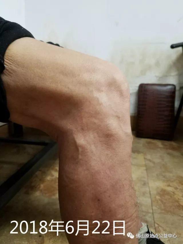 原始点调理全身肿胀溃烂:九个月,雨过天睛 原始点调理全身肿胀溃烂:九个月,雨过天睛