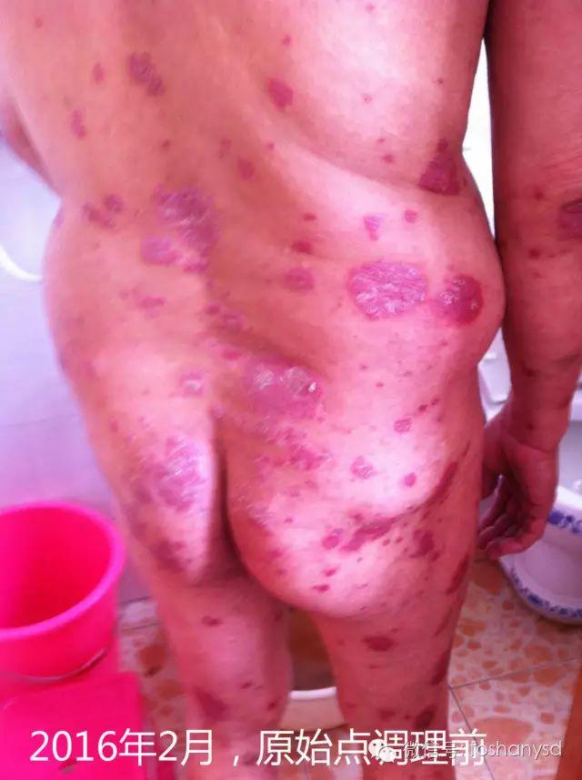 触目惊心 原始点调理八年病史牛皮癣,半年基本恢复健康 触目惊心 原始点调理八年病史牛皮癣,半年基本恢复健康