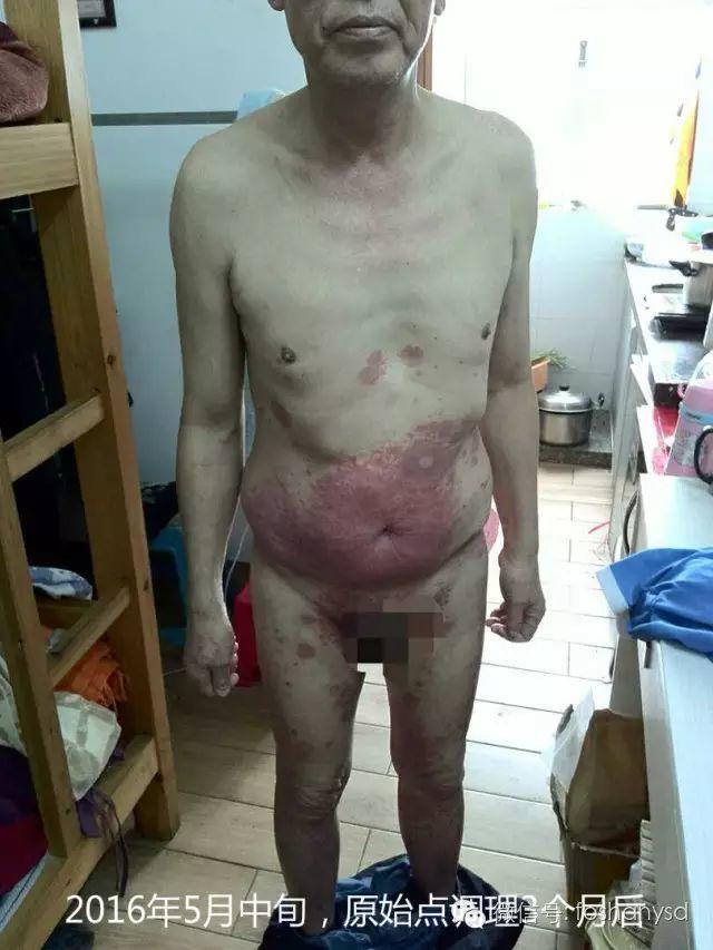 触目惊心 原始点调理八年病史牛皮癣,半年基本恢复健康 触目惊心 原始点调理八年病史牛皮癣,半年基本恢复健康