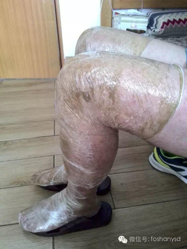 触目惊心 原始点调理八年病史牛皮癣,半年基本恢复健康 触目惊心 原始点调理八年病史牛皮癣,半年基本恢复健康