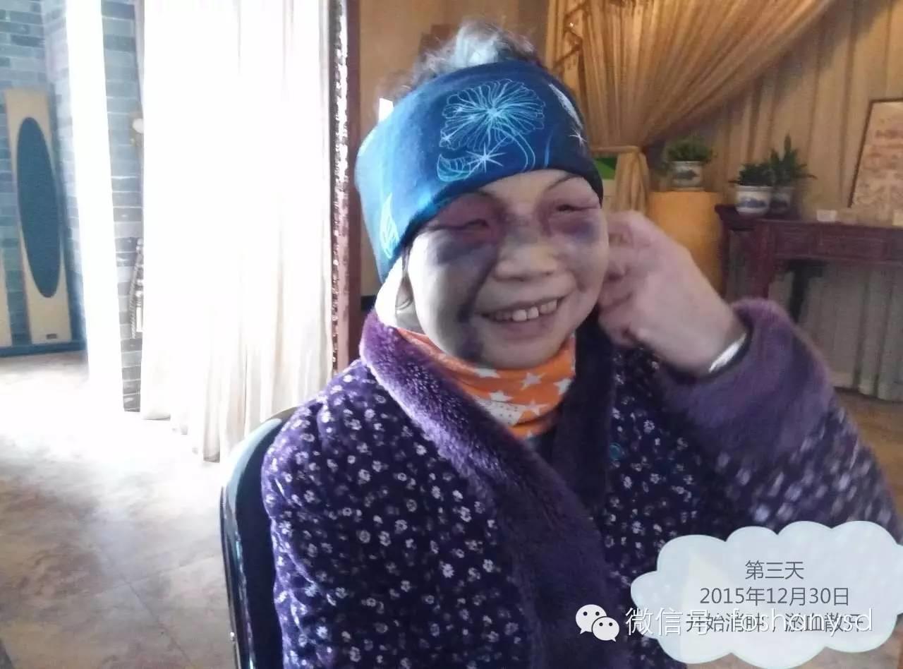 原始点处理摔伤淤肿杠杠的 原始点处理摔伤淤肿杠杠的