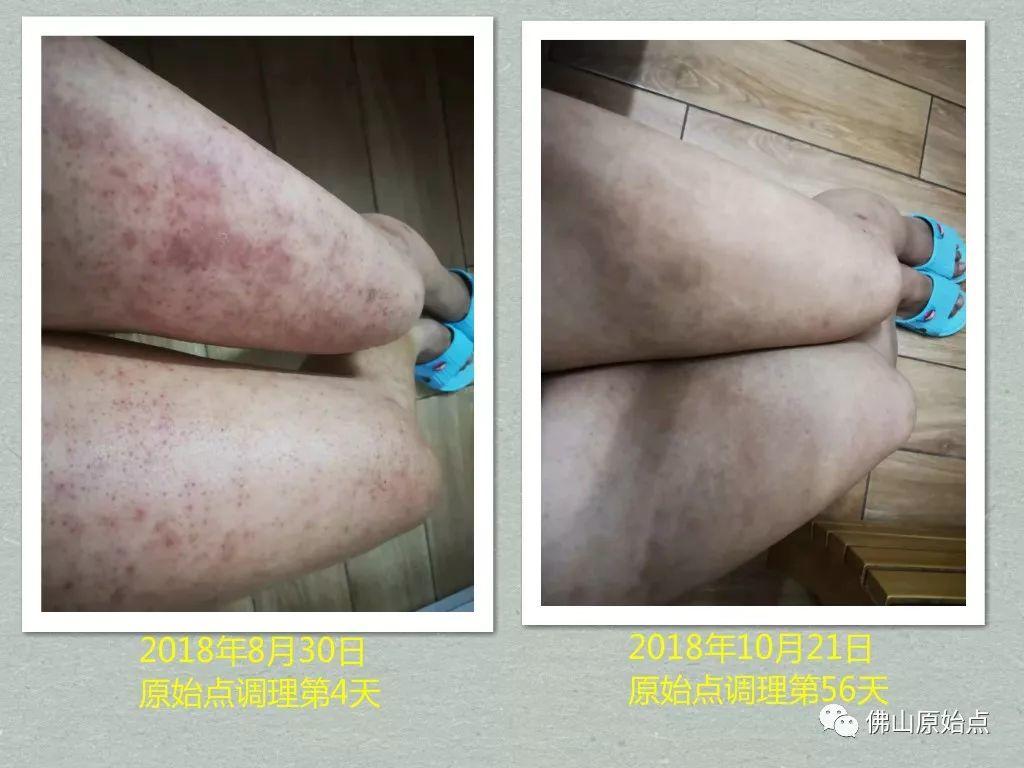 原始点调理严重全身湿疹、荨麻疹:热源是根本 原始点调理严重全身湿疹、荨麻疹:热源是根本