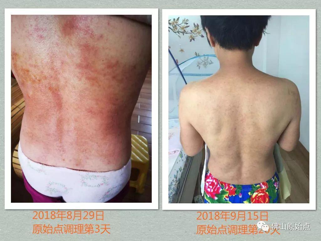 原始点调理严重全身湿疹、荨麻疹:热源是根本 原始点调理严重全身湿疹、荨麻疹:热源是根本