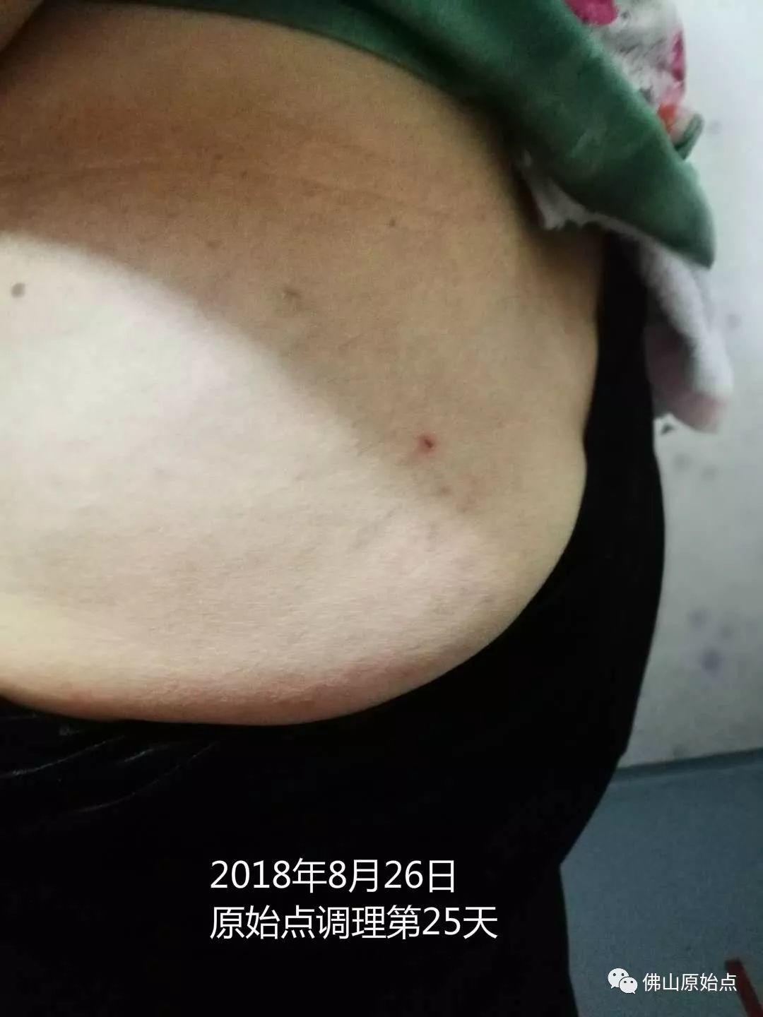 原始点调理带状疱疹:又快又彻底 原始点调理带状疱疹:又快又彻底