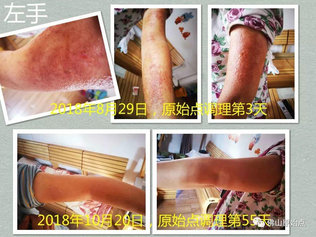 原始点调理严重全身湿疹、荨麻疹:热源是根本 原始点调理严重全身湿疹、荨麻疹:热源是根本
