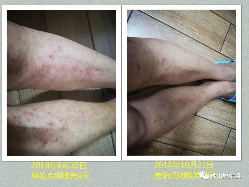 原始点调理严重全身湿疹、荨麻疹:热源是根本 原始点调理严重全身湿疹、荨麻疹:热源是根本