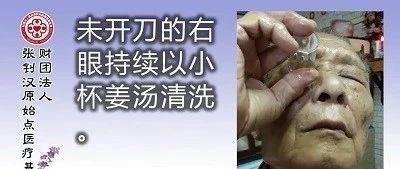 白内障姜汤洗眼案例-七不姜 生姜养生网-明德CSA生态姜园&明安农业